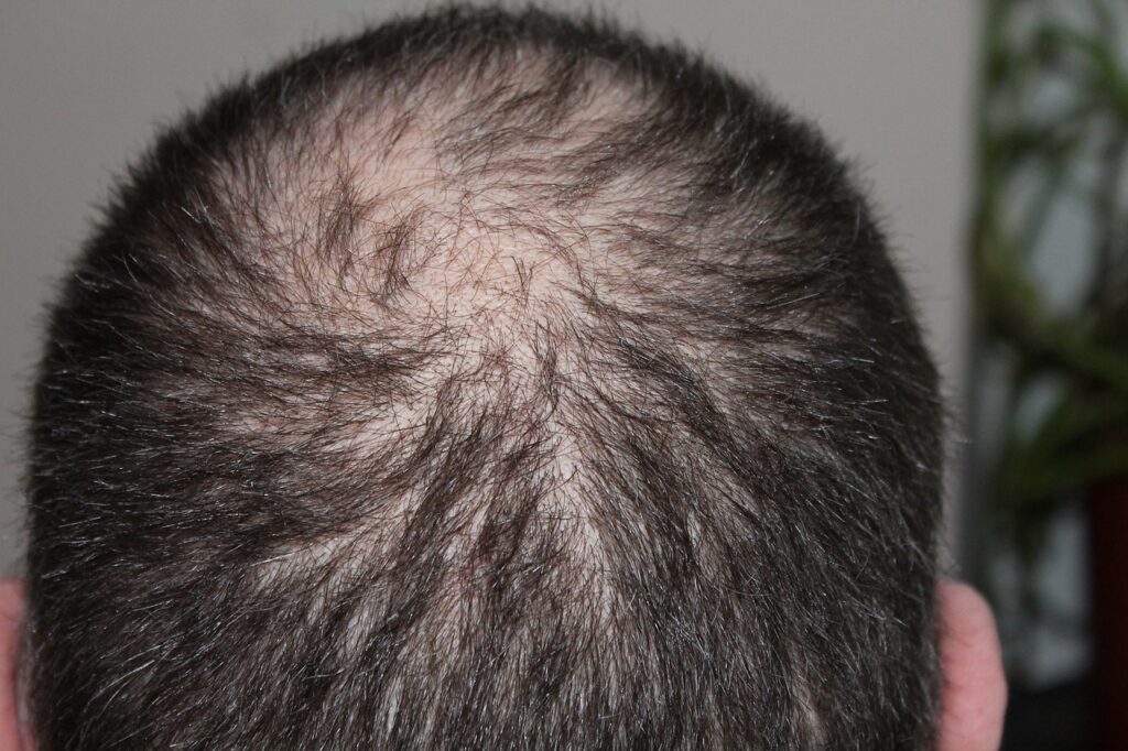 Haarausfall schon in jungen Jahren möglich – Letzte Rettung Haartransplantation