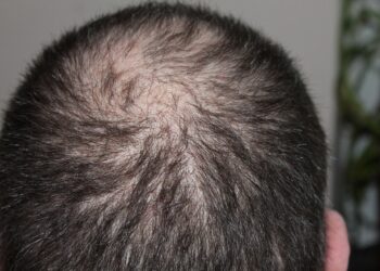 Haarausfall schon in jungen Jahren möglich – Letzte Rettung Haartransplantation