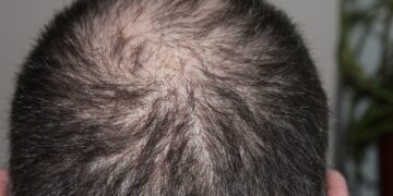 Haarausfall schon in jungen Jahren möglich – Letzte Rettung Haartransplantation