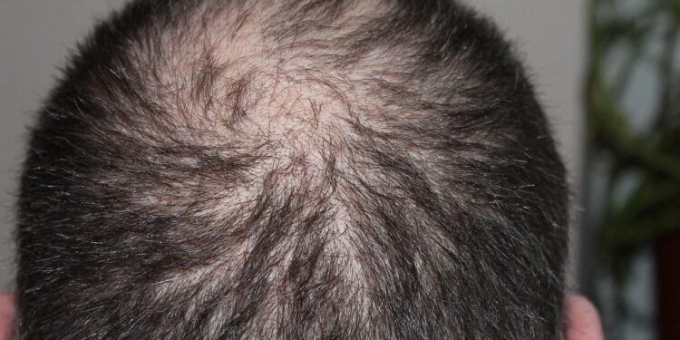 Haarausfall schon in jungen Jahren möglich – Letzte Rettung Haartransplantation